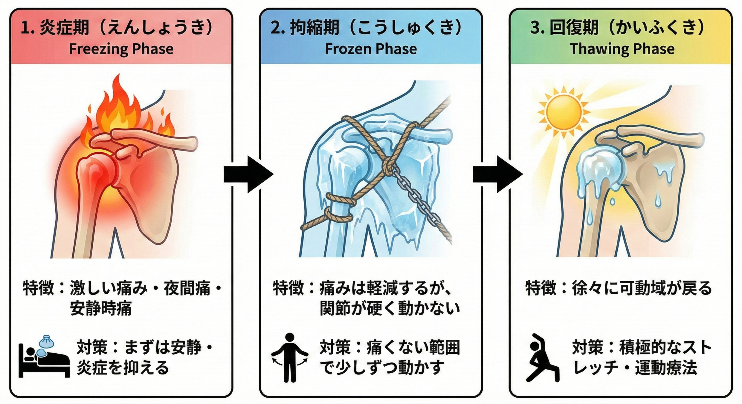五十肩は「動かすべき?」「安静にすべき?」痛みのステージで見極める正しい対処法とメカニズム